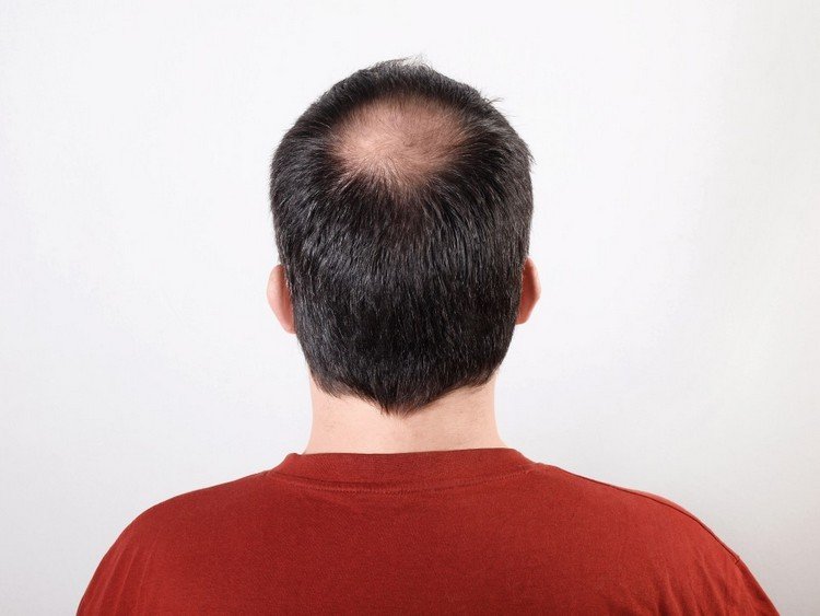 Cirkulært hårtab hos mænd, tonsur på den øverste del af hovedet