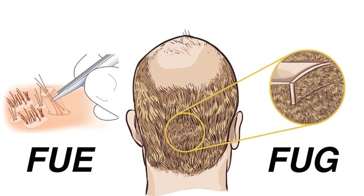 Hårtransplantation-metoder-risici-mænd