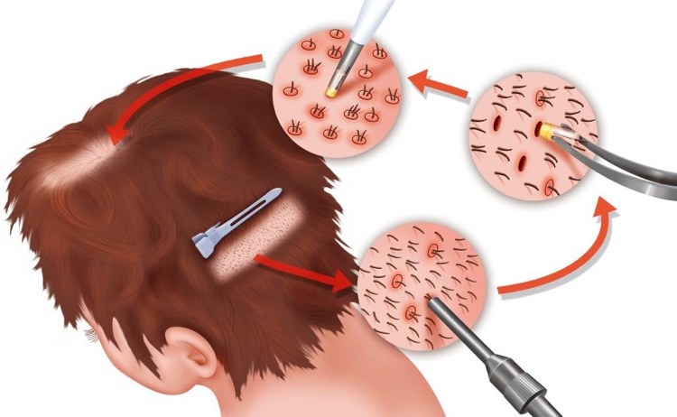 Hårtransplantation-metode-teknik-priser-resultater