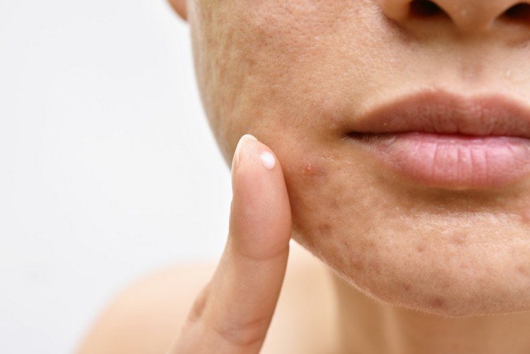 Acne behandling Hvad skal man gøre ved acne og bumser