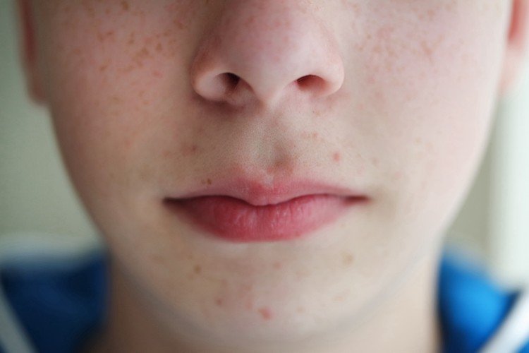 Acne som et problem hos unge og voksne acne behandling