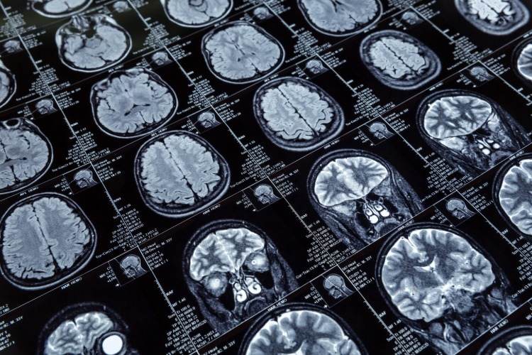 computertomografi af hjernen i tilfælde af demens eller Alzheimers sygdom