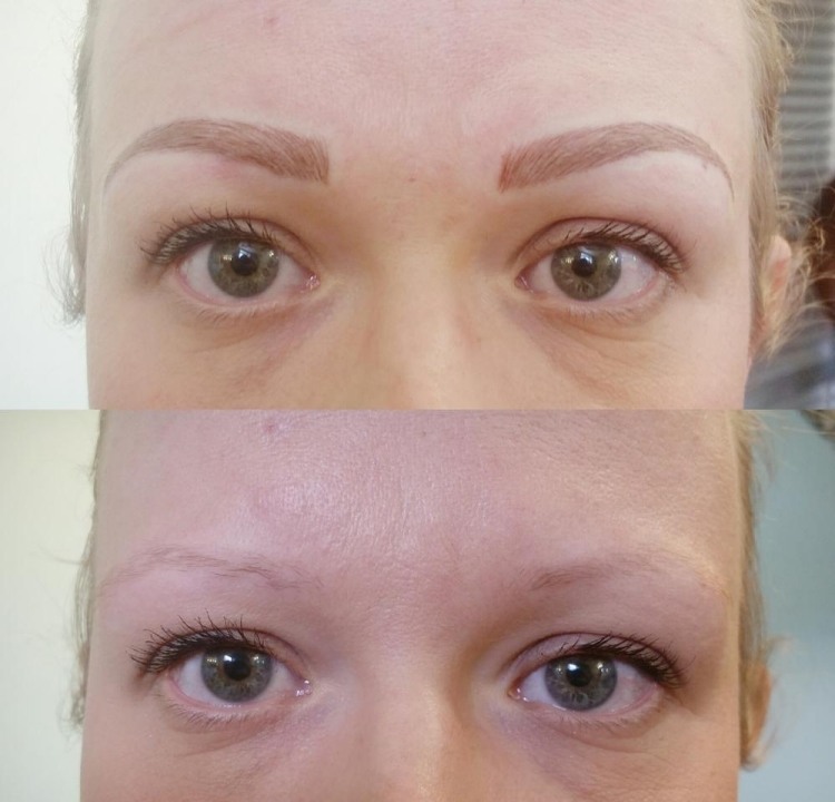permanent-make-up-øjenbryn-sygdom-hår-tegning-streger-3d-effekt