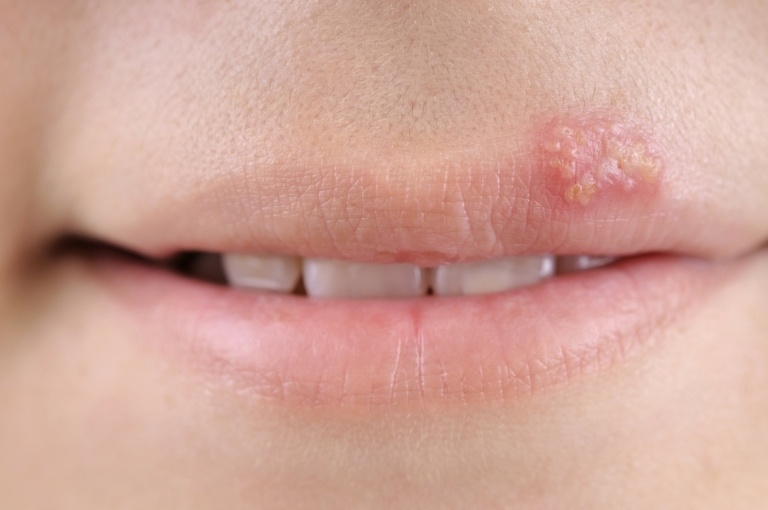 De små blærer på huden er typiske for forkølelsessår og andre former for herpes